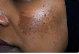 melasma3